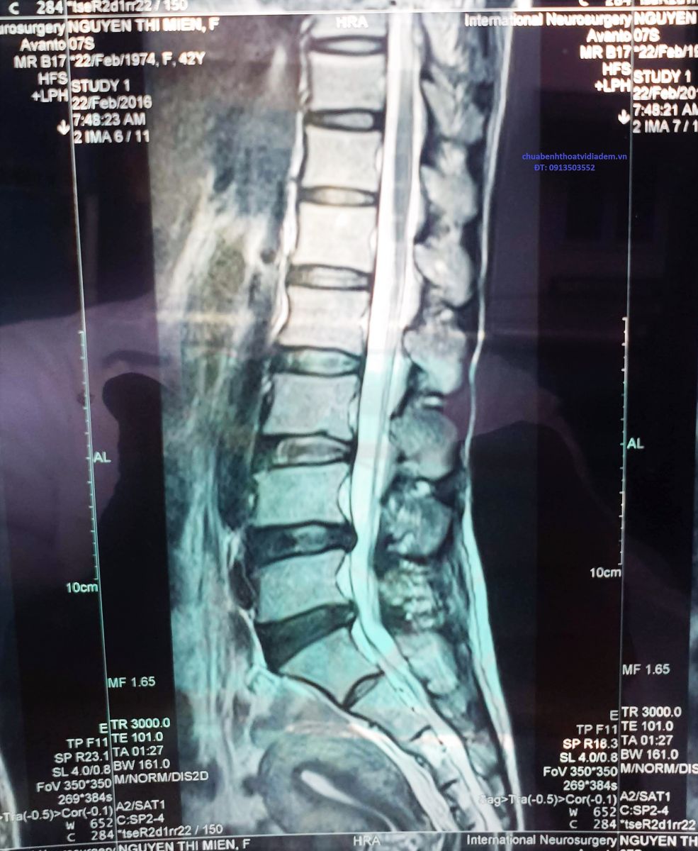 Thoát vị đĩa đệm cột sống thắt lưng